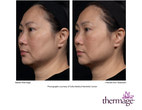 Results using the new Total Tip from Thermage﻿!